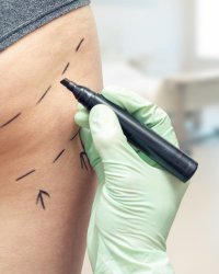 Comment la chirurgie des fesses a détrôné celle des seins ?