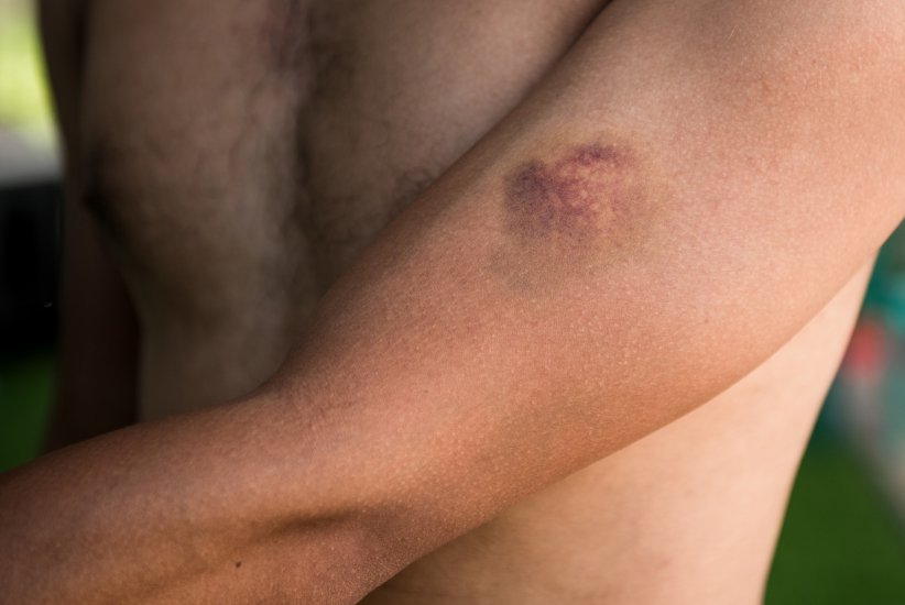 La contusion La contusion