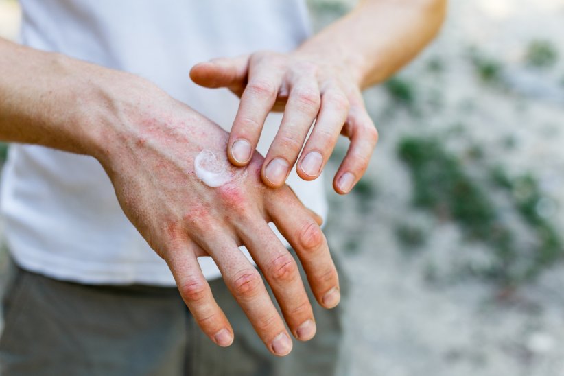 L'eczéma ou dermatite atopique L'eczéma ou dermatite atopique