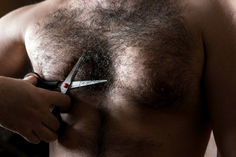 L'hypertrichose, connue comme le syndrome du loup-garou L'hypertrichose, connue comme le syndrome du loup-garou