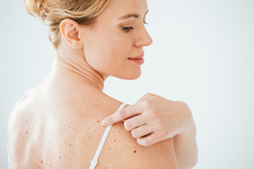 Observer ses grains de beauté pour détecter un cancer de la peau Observer ses grains de beauté pour détecter un cancer de la peau