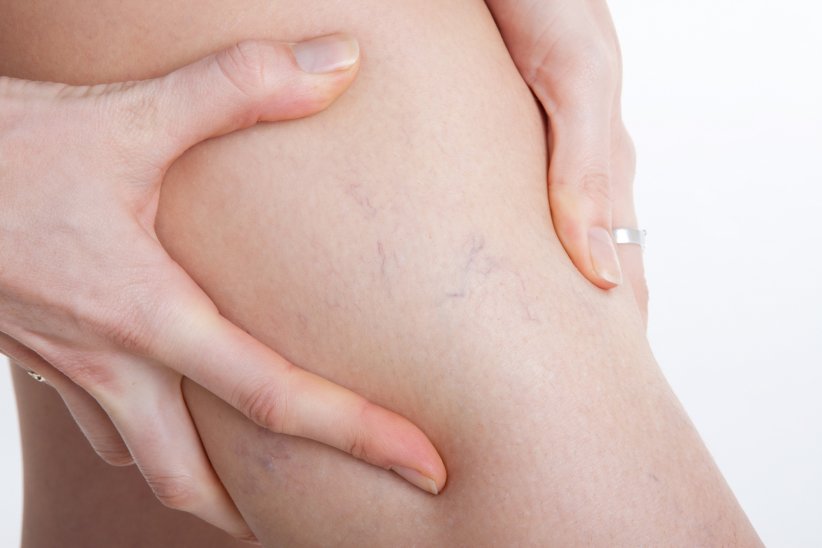 Les varices Les varices