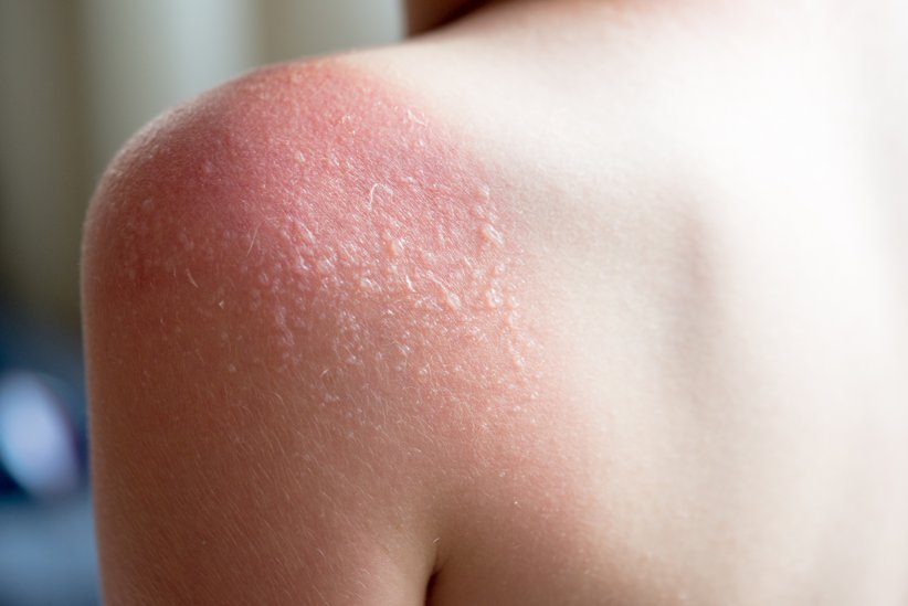Coup de soleil : comment ne pas peler ? Coup de soleil : comment ne pas peler ?