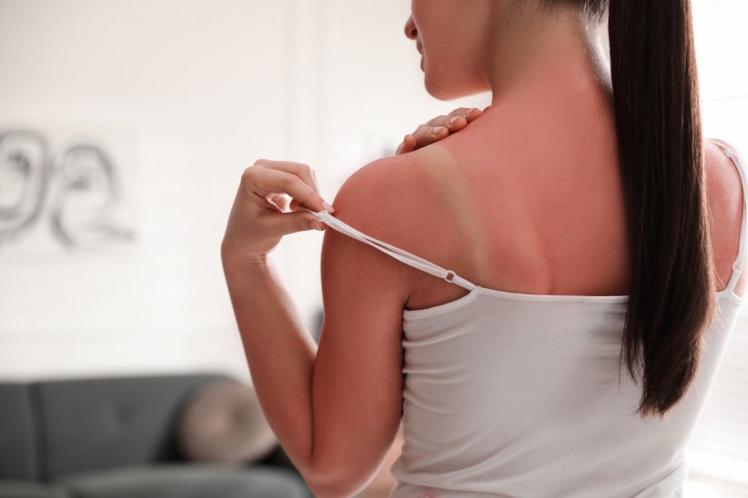 Qu'est-ce qu'un coup de soleil ? Qu'est-ce qu'un coup de soleil ?