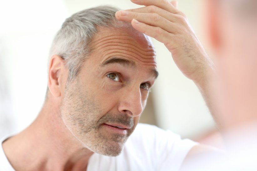 Les implants capillaires Les implants capillaires