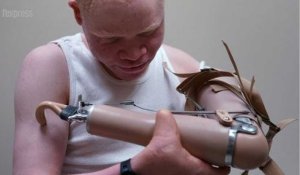 Un enfant albinos mutilé en Tanzanie reçoit une prothèse