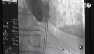 CHU Rennes pose de la 1000e valve aortique par voie artérielle TAVI