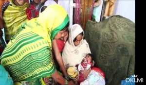 Un bébé né avec une trompe d'éléphant en Inde