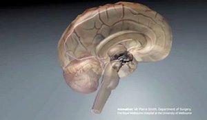 Un implant cérébral pourrait faire remarcher les personnes paralysées