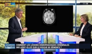 Comment les lésions hémorragiques cérébrales influent-elles sur le risque de démence ?- 04/06