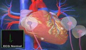 La tachycardie ventriculaire en vidéo