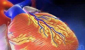 L'angioplastie expliquée en vidéo