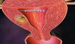 Le cancer de l'utérus expliqué en vidéo
