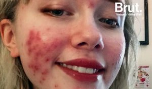 Sur Instagram, ils affichent leur acné sans tabou