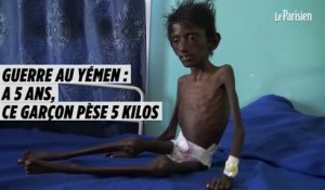 Guerre au Yémen : Abdel Rahmane, 5 ans, pèse 5  kilos