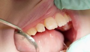 Santé - Les dents de l’enfant sous surveillance