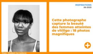 Cette photographe capture la beauté des femmes atteintes de vitiligo : 18 photos magnifiques