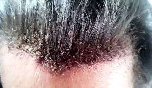 Les cheveux d'une femme ravagés par des milliers de poux