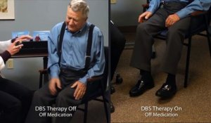 Symptomes de la maladie de Parkinson avec et sans Neurostimulateur DBS