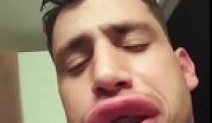 Il Est Completement Defigure Suite A Deux Piqures De Guepes Sur La Levre Superieure Sur Orange Videos