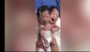 Des parents mettent en ligne la vidéo de leurs jumeaux nés avec deux têtes et un seul corps au Mexique