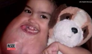 Cet enfant de 3 ans se fait opérer d'une tumeur au visage énorme!