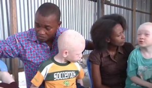 Rd congo, Intégration sociale des Albinos/les albinos se prennent en charge