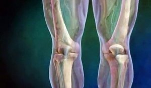 L'arthroplastie du genou expliquée en vidéo