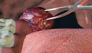 L'amygdalectomie expliquée en vidéo