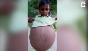 Cet enfant Pakistanais au ventre surgonflé va etre opéré car sa vie est en danger