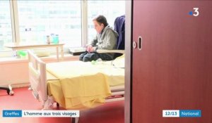 Santé : deuxième greffe du visage et première mondiale pour Jérôme Hamon