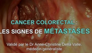 Cancer colorectal :  3 symptômes de métastases