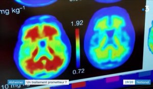 Alzheimer : une molécule redonne espoir aux chercheurs