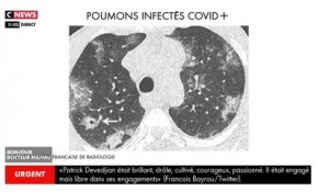 Le docteur Milhau dévoile des images inédites de poumons atteints par le Covid-19