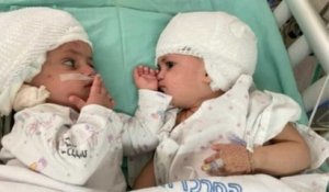 Ces sœurs siamoises reliées par la tête se découvrent pour la première fois après leur opération