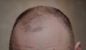 Une nouvelle étude identifie la source de la perte de cheveux