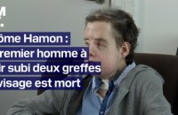 Jérôme Hamon, le premier homme avec deux greffes au visage est mort