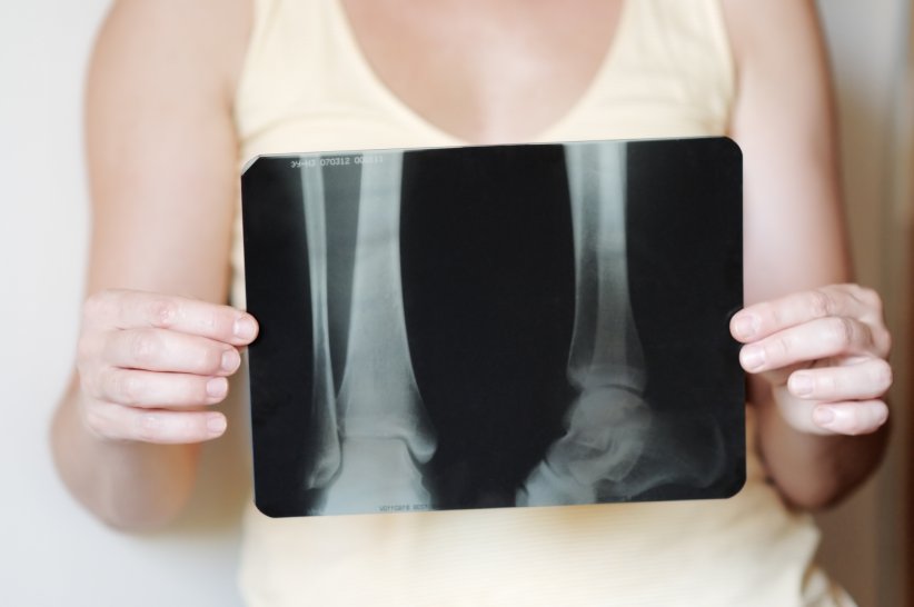 L'ostéoporose est une maladie qui fragilise les os et augmente le risque de fracture.